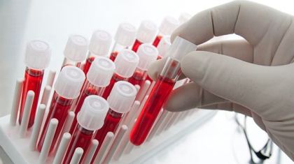 Tratan cáncer de sangre con virus de sarampión | HISPANTV